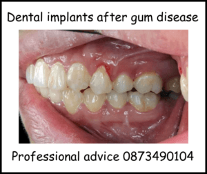 Dental implants after gum disease image