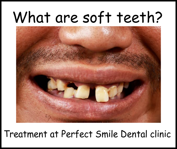 What are soft teeth image