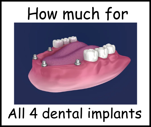 How much for all 4 dental implants image