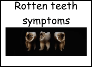 Rotten teeth symptoms image