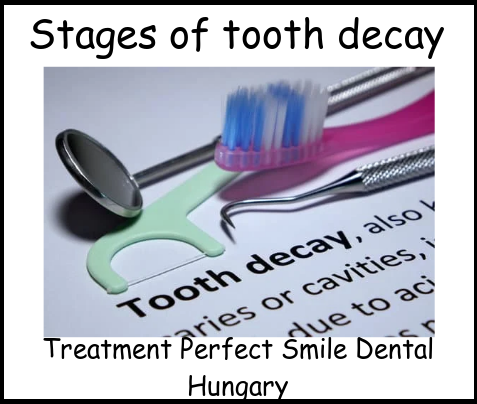 Stages of tooth decay image