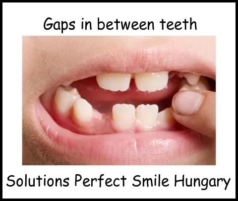 Gaps in between teeth image