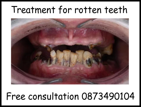 Treatment for rotten teeth image