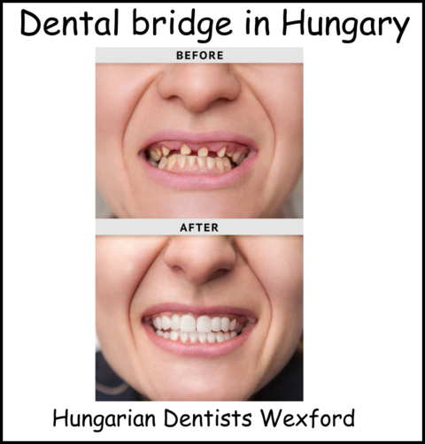 Dental bridge in Hungary image