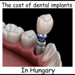 The cost of dental implants in Hungary image