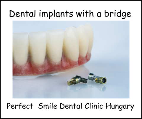 Dental implants with a bridge image