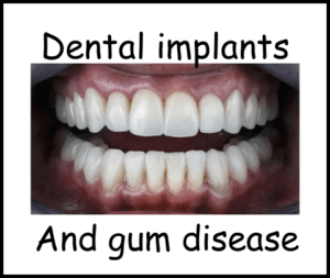 Dental implants and gum disease image