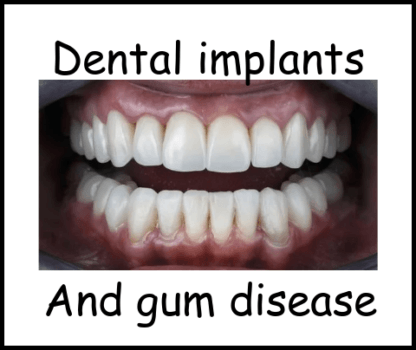 Dental implants and gum disease image