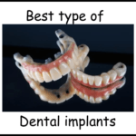 Best type of dental implants image