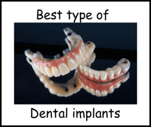 Best type of dental implants image