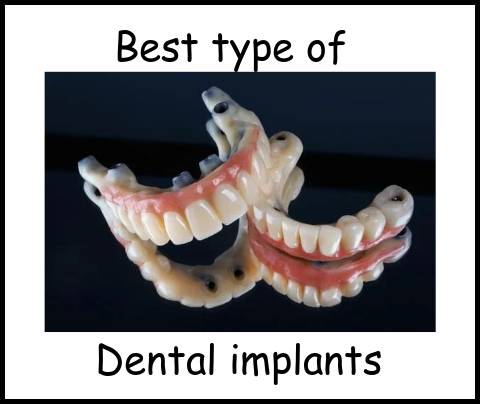 Best type of dental implants image