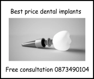 Best price dental implants free consultation image