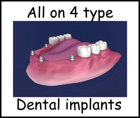 All on 4 type dental implants image