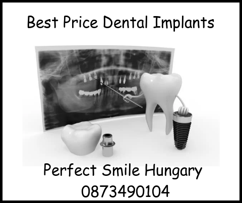 Best price dental implants image