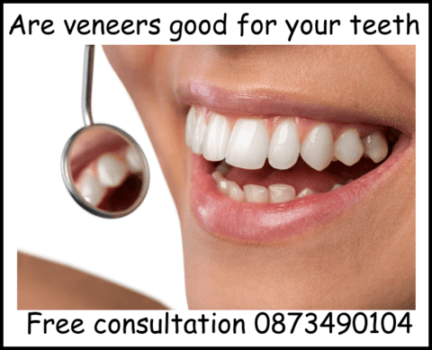 Are veneers good for your teeth image