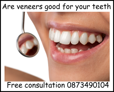 Are veneers good for your teeth image