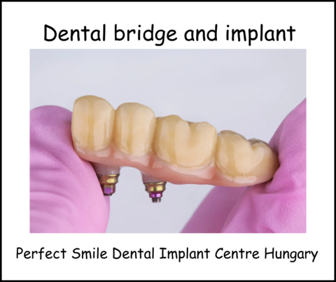 Dental bridge and implant image