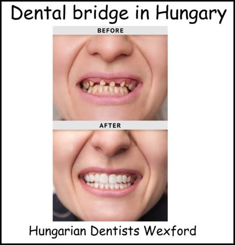 Dental bridge in Hungary image 