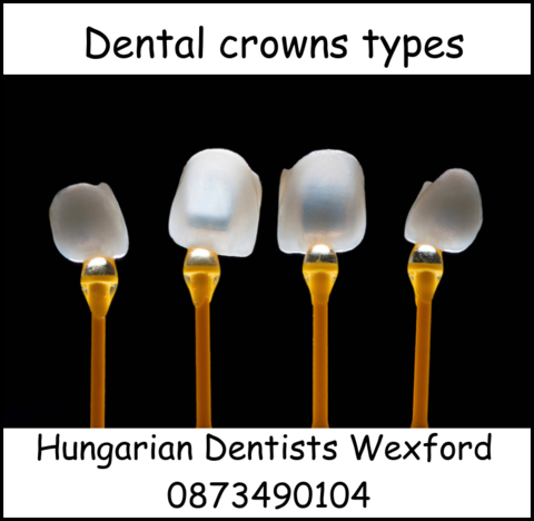 Dental crowns types image 