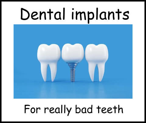 Dental implants for really bad teeth image 