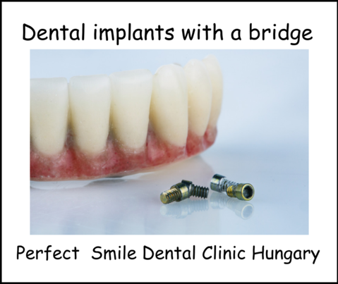 Dental implants with a bridge image