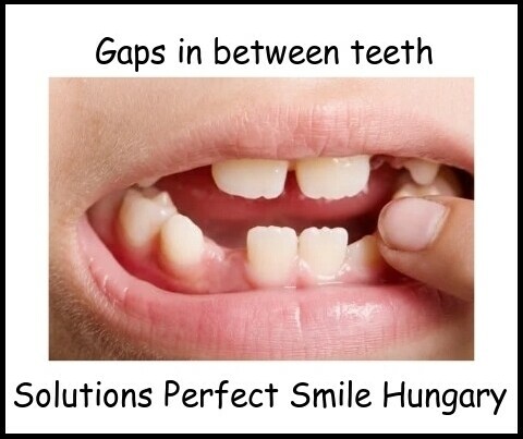 Gaps in between teeth image 