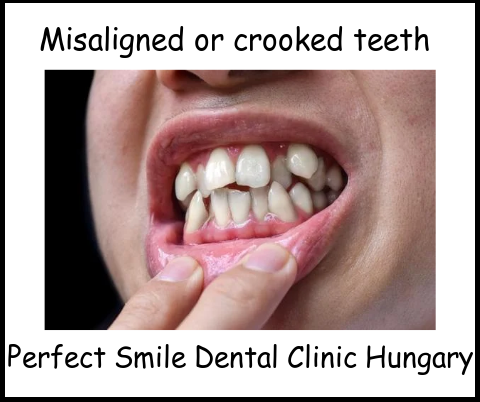 Misaligned or crooked teeth image