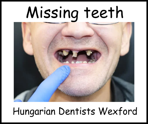 Missing teeth image