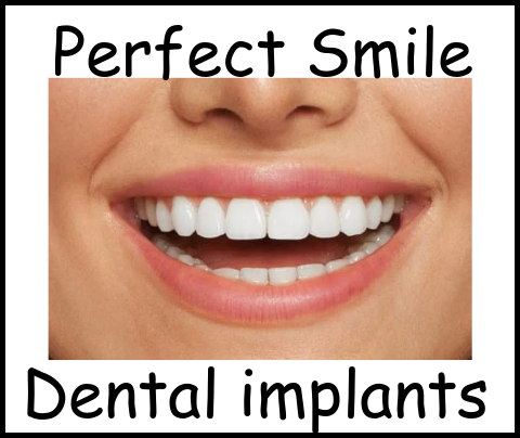 Perfect Smile dental implants image