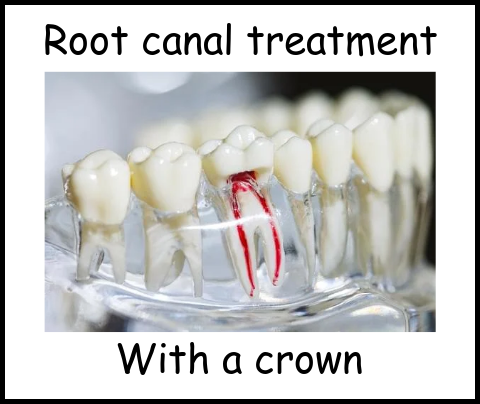 Root canal treatment with a crown image