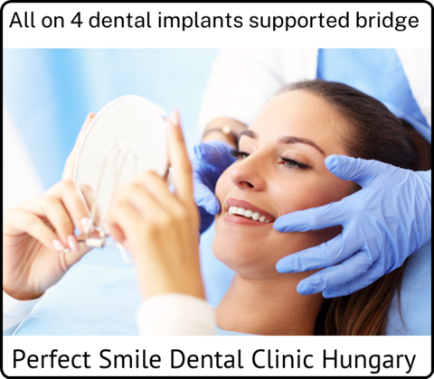 All on 4 dental implants supported bridge image