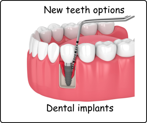 Dental implants image 