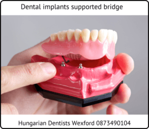 Dental implants supported bridge image