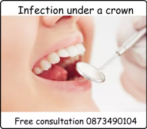 Infection under a crown image