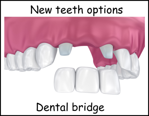 New teeth options dental bridge image