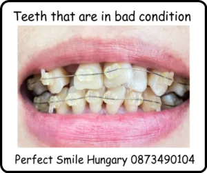 Teeth that are in bad condition image