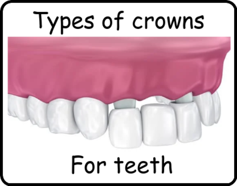 Types of crowns for teeth image