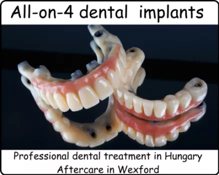 All-on-4-dental implants image