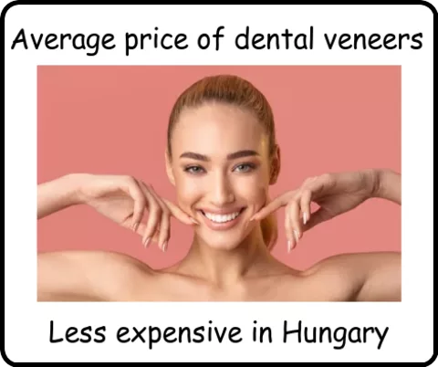 Average price for dental veeners image