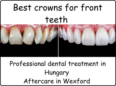 Best crowns for front teeth image 1