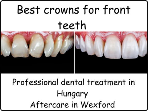 Best crowns for teeth image 2