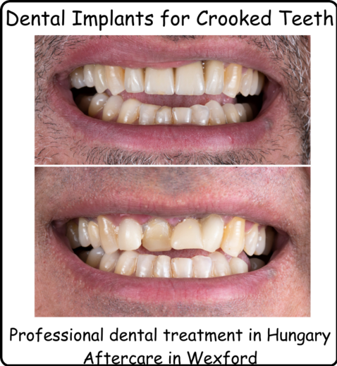 Dental implants for crooked teeth image 1