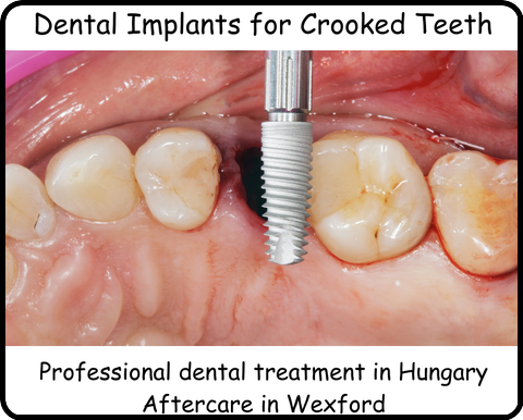 Dental implants for crooked teeth image 2