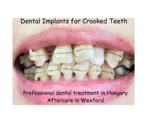 Dental implants for crooked teeth in Hungary image