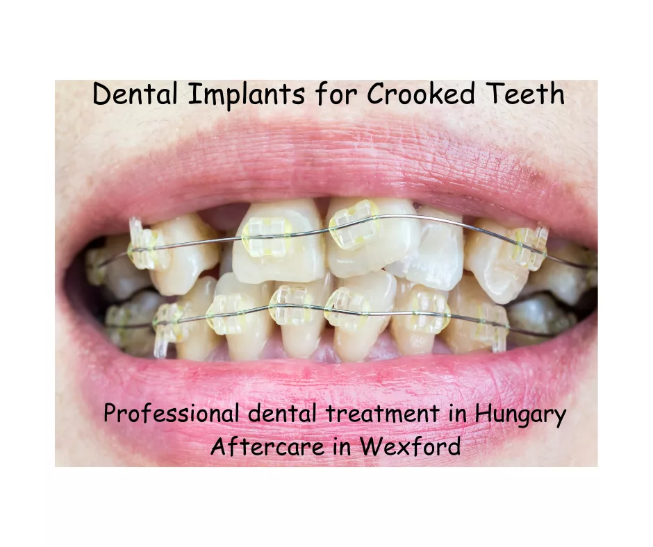 Dental implants for crooked teeth in Hungary image