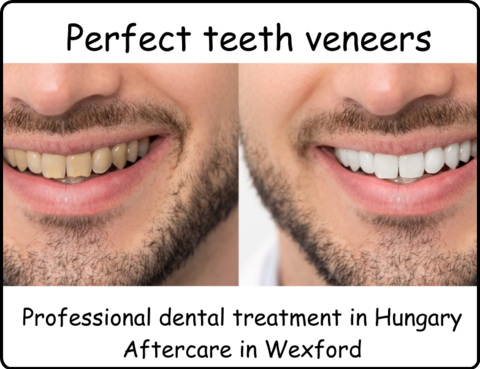 Perfect teeth veeners image 1