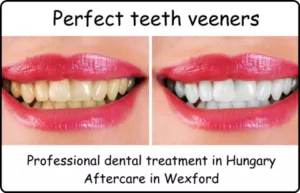 Perfect teeth veeners female image