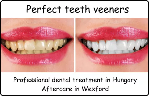 Perfect teeth veeners female image