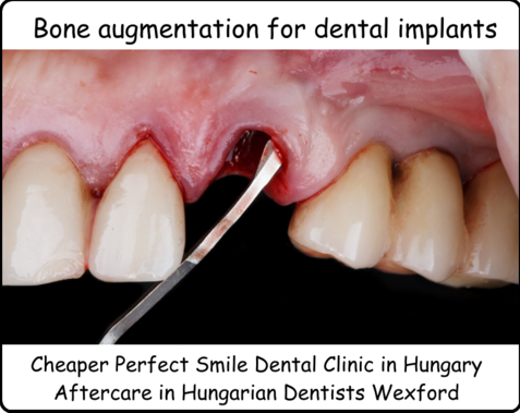 Bone augmentation for dental implants image