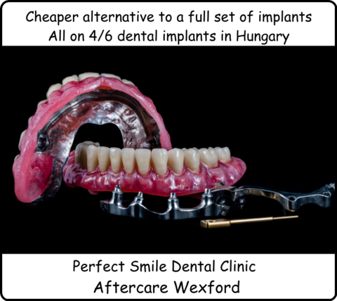 Cheaper alternative to a full set of dental implants all on 4/ 6 dental implants image